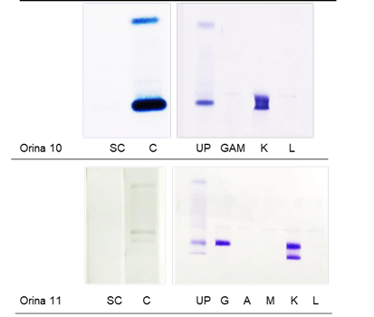 Uroproteinograma e inmunofijación de las orinas tipo mielomatosas.
