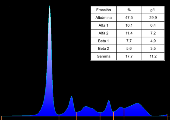 Proteinograma electroforético en suero.