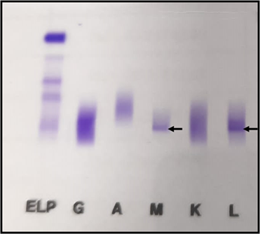Inmunofijación en suero.