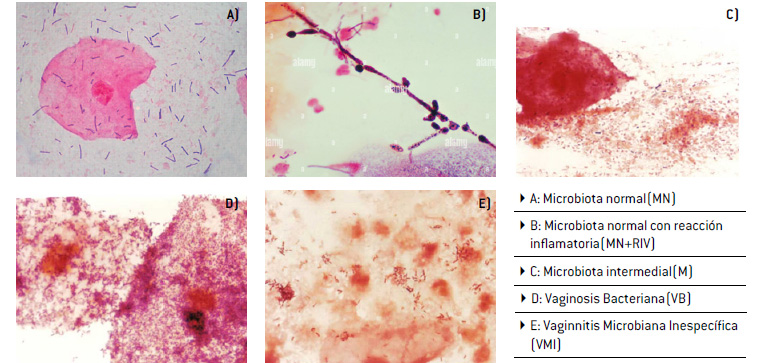 Estados vaginales básicos (EVB): observación en la coloración de Gram (1000X) del contenido vaginal